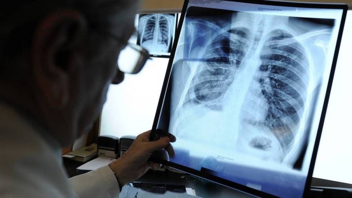 JSST: Pandemiya davrida tuberkulyozdan o‘lim ko‘rsatkichlari oshgan